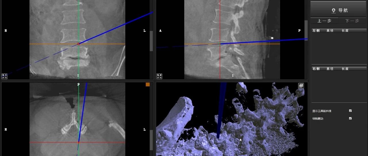 AR超視覺導航輔助下腰椎後路減壓融合內固定術在上海長征醫院成功完成