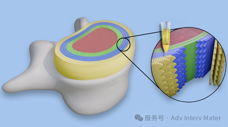 蘇州大學李斌/李家穎/馬進進團隊 Adv Interv Mater ——3D 列印椎間盤綜述