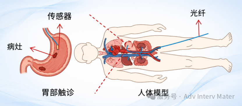 中國科學院深圳先進技術研究院董玉明團隊Adv Interv Mater——微創監控用光纖布拉格光柵感測器：